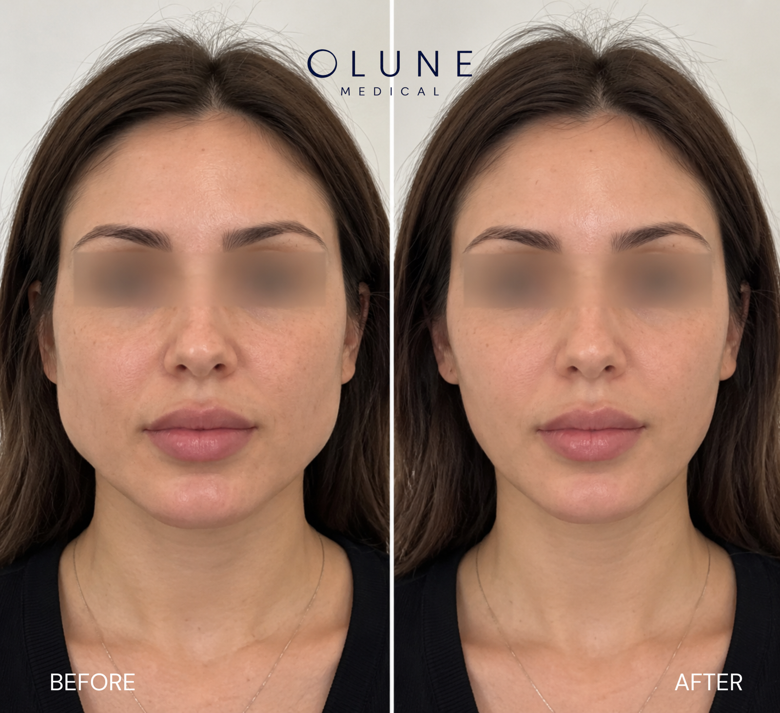 Bruxism Before_After.