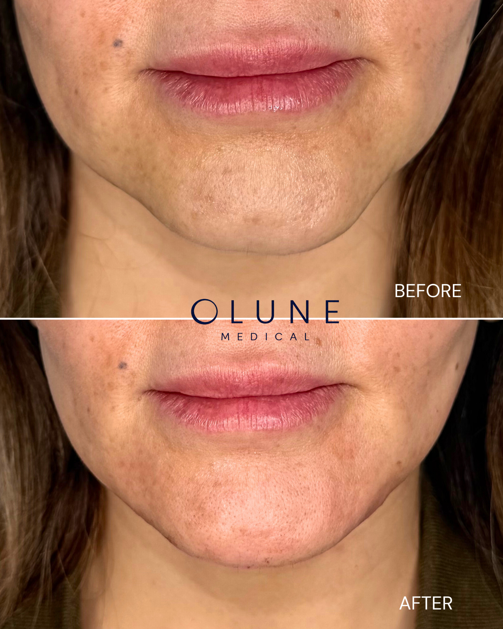 Chin Filler Before_After.