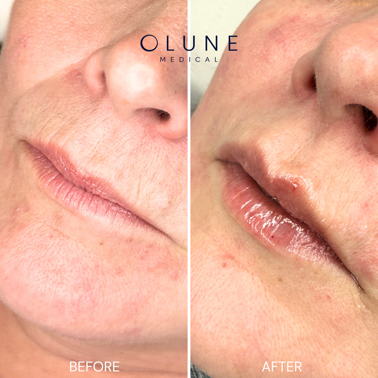 Lips Before_After.