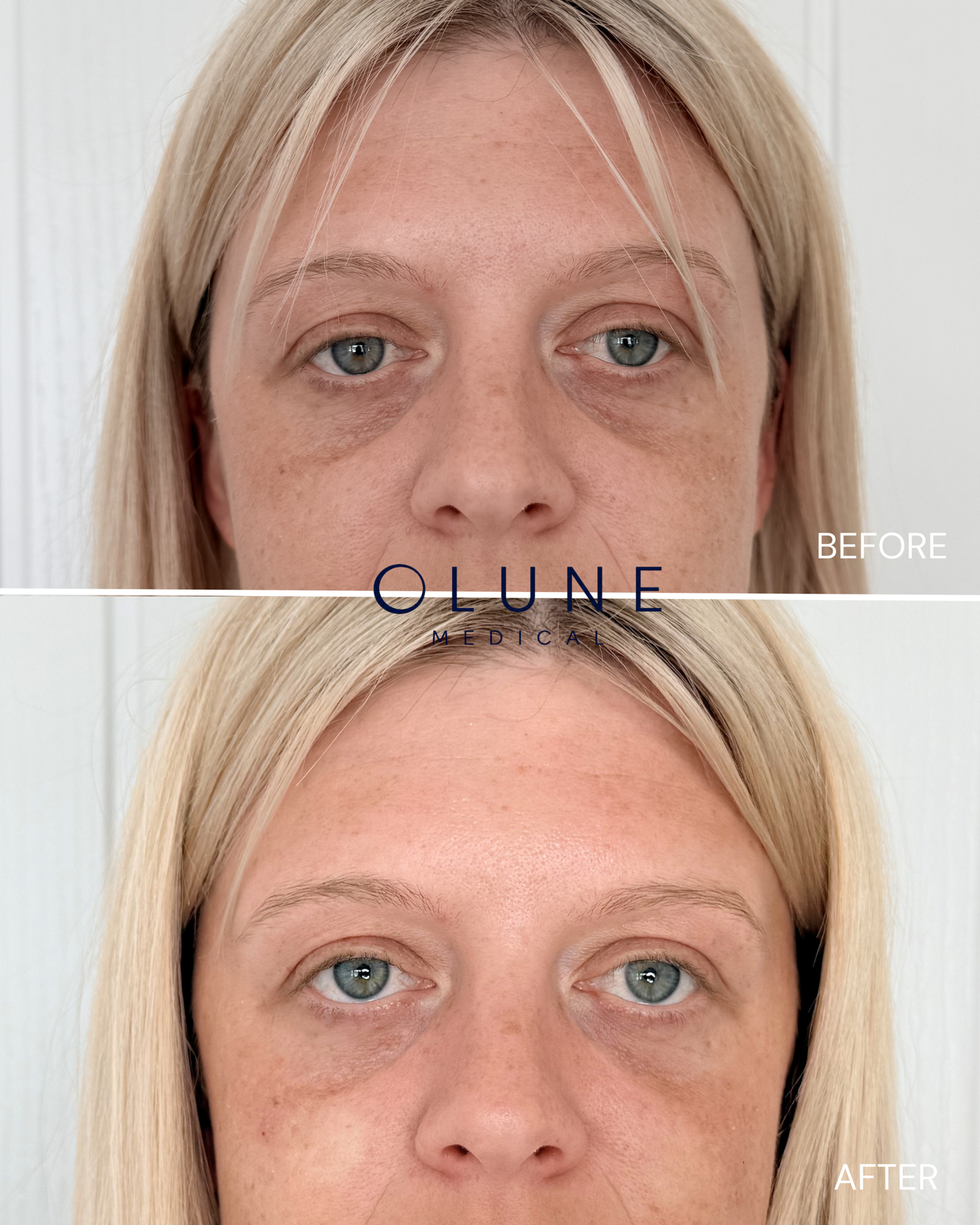 Tear Trough Before_After.