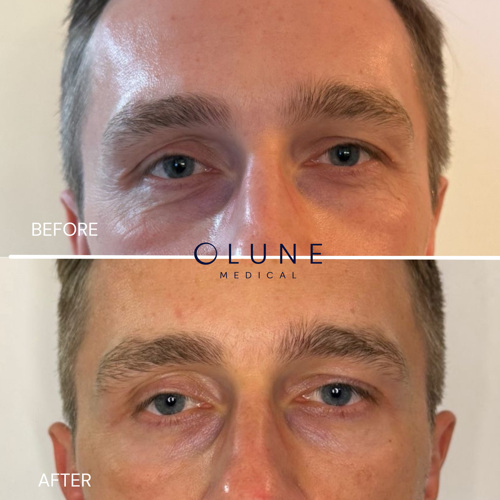 Dark circles before after